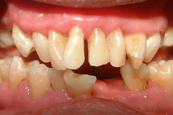 インプラントの注意点