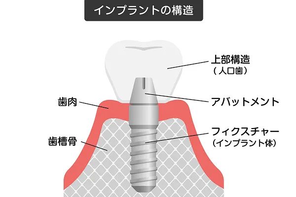インプラントとは
