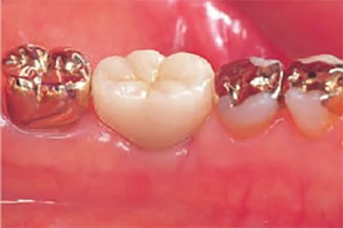 インプラントの上から義歯をかぶせる