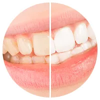 ホワイトニング